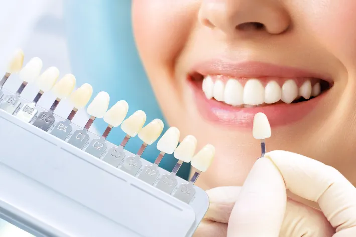 Dental Veneers